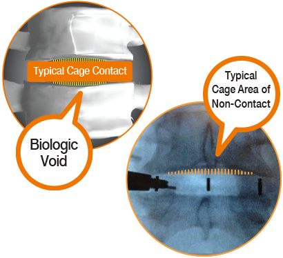 Diagram showing Typical Cage Contact within Biologic Void, and Typical Cage Area of Non-Contact