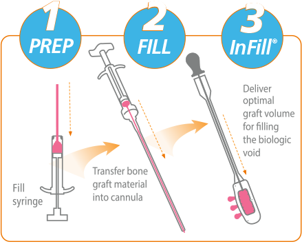 1 Prep, 2 Fill, 3 InFill. Fill syringe, Transfer bone graft material into cannula, Deliver optimal graft volume for filling the biologic void.